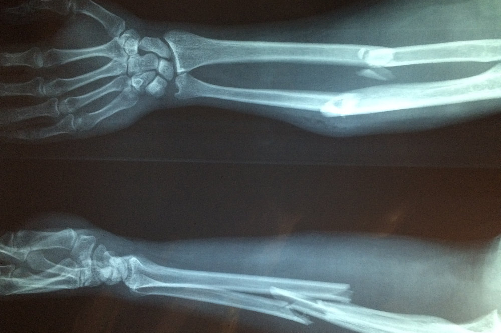 Bone fracture in arm